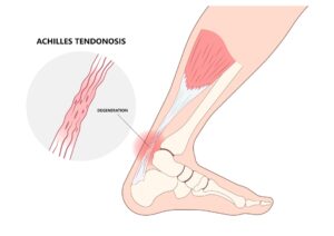 Heel pain, Achilles tendonitis, KC Foot Specialists, Overland Park, 2025,-min