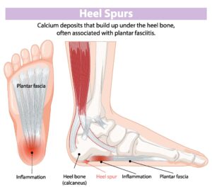 Heel pain, heel spur, KC Foot Specialists, Overland Park, 2025,.jpeg -min