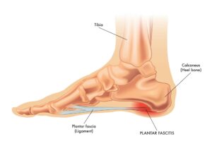 Heel pain, plantar faciitis, KC Foot Specialists, Overland Park, 2025,-min