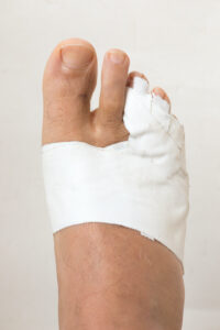 Toe injuries, broken toe, Kansas City Foot Specialists, 2025.jpeg